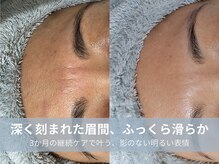 ラシック 加古川店(La chic.)/眉間とおでこのエイジングケア