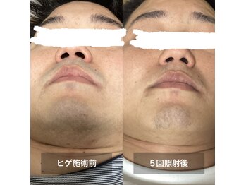 リリー(RILY)/【ビフォーアフター】