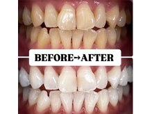 ホワイトニングサロン 豊中/Before&After美白ホワイトニング