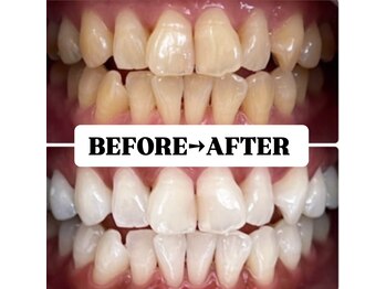 ホワイトニングサロン 豊中/Before&After美白ホワイトニング