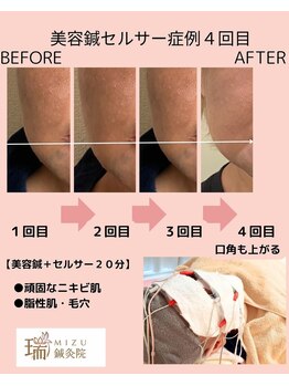 瑞 鍼灸院/にきび　美容鍼セルサー4回