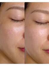 タイトプラス(tyto+)/プラチナプラピール