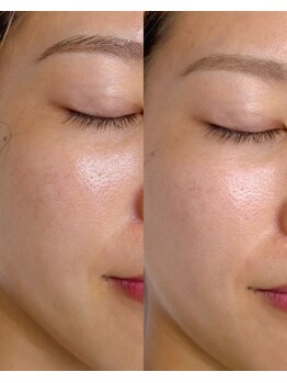 タイトプラス(tyto+)/プラチナプラピール