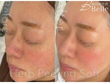 ベル 代々木店(Belle)/#毛穴#ニキビケア#代々木#新宿