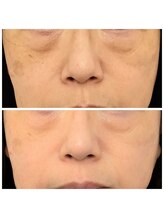 イーオ(io)/たるみ改善！