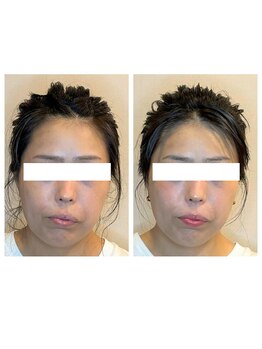 ビーサロン(B-salon)/左右差/小顔コルギ