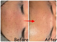 エレ(ele)の雰囲気（初めての方◎肌のごわつき、角質落としてすっきり美肌★施術1回）