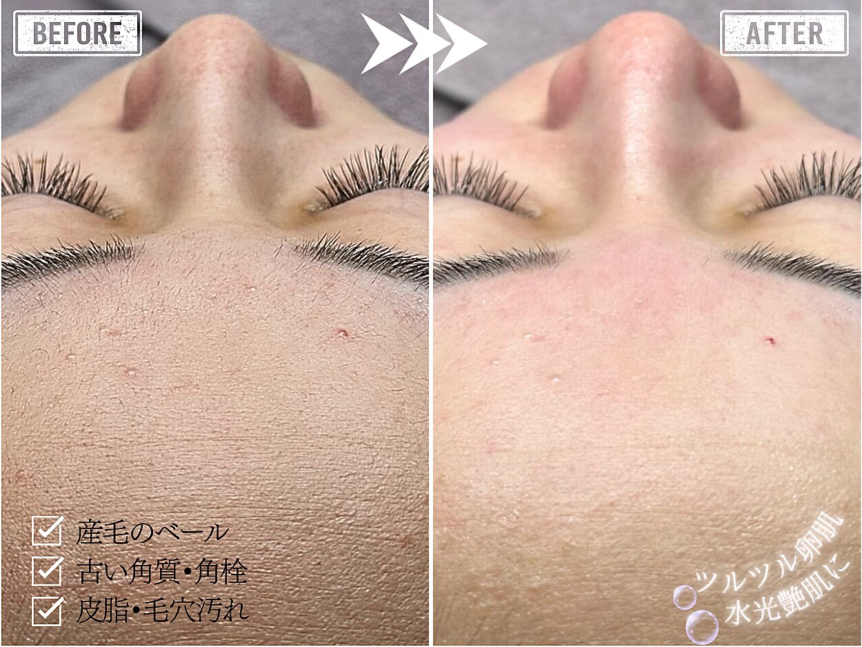 業務用フェイシャルワックス　艶肌wax 26個 ホワイトワックス 新宿店(WHITE WAX)｜ホットペッパービューティー