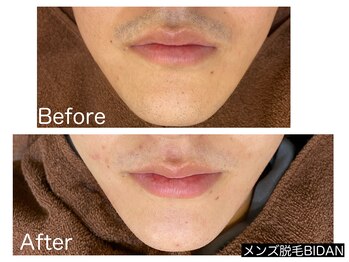 ビダン(BIDAN)/ヒゲ脱毛 BeforeAfter