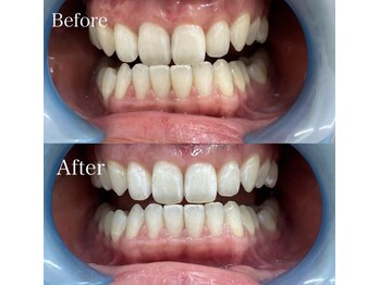 ベルカーラ(Belcarra)/BIHAKU セルフホワイトニング