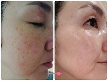 アズ(AZU)/●before after