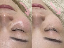 アルム(a'lm)/リフトアップ！憧れの小顔にも♪