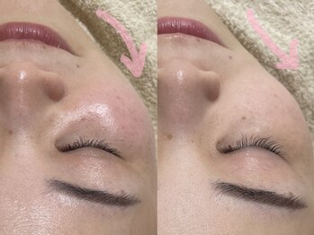 アルム(a'lm)/リフトアップ！憧れの小顔にも♪