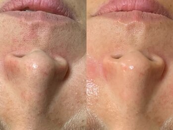 ハレオラ(HaleOla)/40代★1度目から毛穴つるつる♪