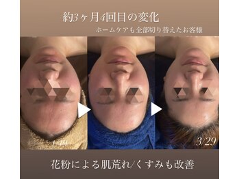 オーシャンブルーム 目黒(OceanBloom)/赤み/乾燥／敏感肌