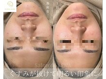 サロンドレナ 名駅店/ハーブピーリング サロンドレナ