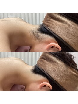 エステティック レイビス 池袋店(RAYVIS)/うなじ脱毛