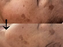 サロン ドロップ 上小田井(Salon drop)/「シミ改善」途中経過