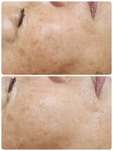 プレイス 天王寺店(PLACE)/ハーブピーリング