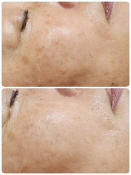 プレイス 天王寺店(PLACE)/ハーブピーリング