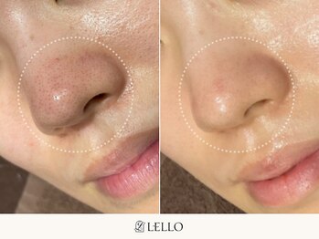 レロ 恵比寿店(LELLO)/毛穴レスのお肌になりたい方へ