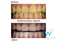 ホワイトニングショップ 甲賀店/Before&After『ホワイトニング』