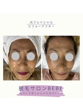 ベベ(Bebe)/光フェイシャル