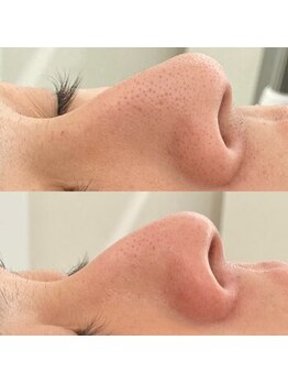 ウルト(ULT)/メンズも毛穴洗浄で変わる！！