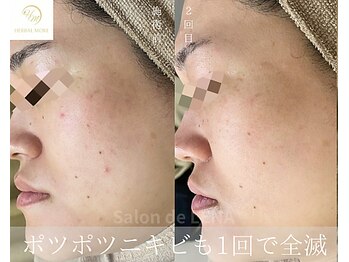 サロンドレナ 名駅店/ハーブピーリング サロンドレナ