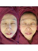 ナル(naru.)/臍帯羊膜1回で目元ふっくら