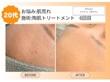 ムーンサン(Moon sun)/20代　陶肌トリートメント