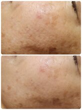 プレイス 天王寺店(PLACE)/ハーブピーリング