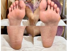 ビサンテ サロン/フットネイル自爪&角質ケア後-3