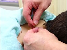 くどう鍼灸接骨院/鍼