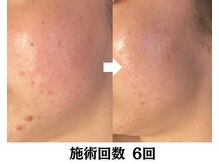 バース(Birth...)/ハーブピーリング/ニキビケア