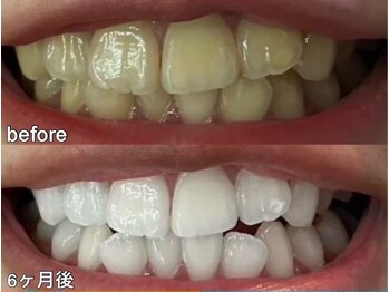 グラーティア 奈良王寺店/ホワイトニング★6ヶ月目★