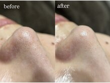 ビビ(Vivi)/毛穴洗浄