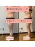 Summer！！★脂肪冷却４カップ】お腹＋腰　初回¥22000→¥11800