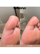 マオヌー(MAONU)/韓国式角質ケア　症例写真