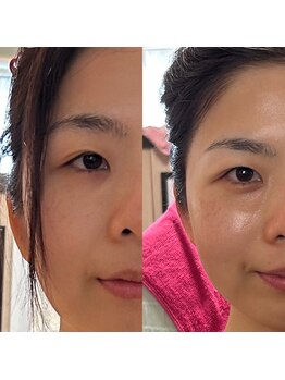 ソッテ(sotte)/ツルツル剥きたて卵肌に♪