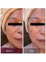 シュガー(Sugar...iyr)/ハーブピーリング