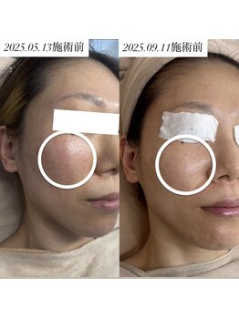 お肌想いラボ/4ヶ月後の毛穴変化