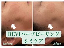 ミモザ(Mimosa)の雰囲気（ハーブピーリングでエイジングケア♪延髄スプレーガン使用）