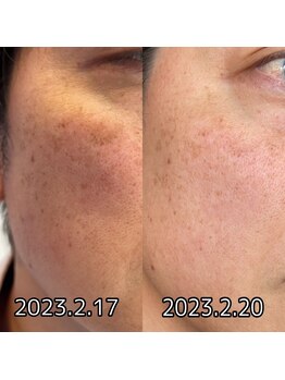 ビーアンドビー(B&B)/エクソソーム美肌コース