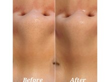 アリュール(Allule)/毛穴改善