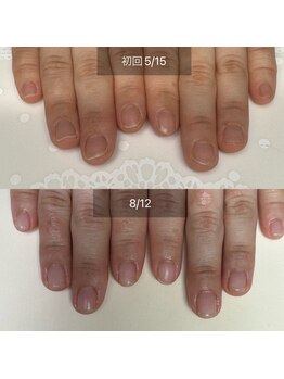 シープラス/看護師さんジェルで自爪育成