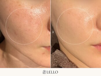 レロ 恵比寿店(LELLO)/頑固な黒ずみもスッキリ綺麗に