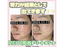 ホワイトアクア 岐阜店(WHITE AQUA)/ハーブピーリング/岐阜/ニキビ