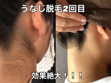 リエル(RIEL)の雰囲気（【うなじの脱毛写真】ご希望デザイン可能。目指すは首元美人！）