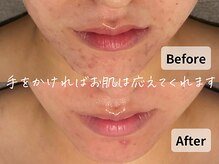 バタフライ 平塚店(Butterfly)/消えなかった茶色い跡が綺麗に